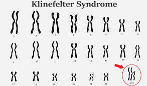 figure2)Klinefelter Syndrome