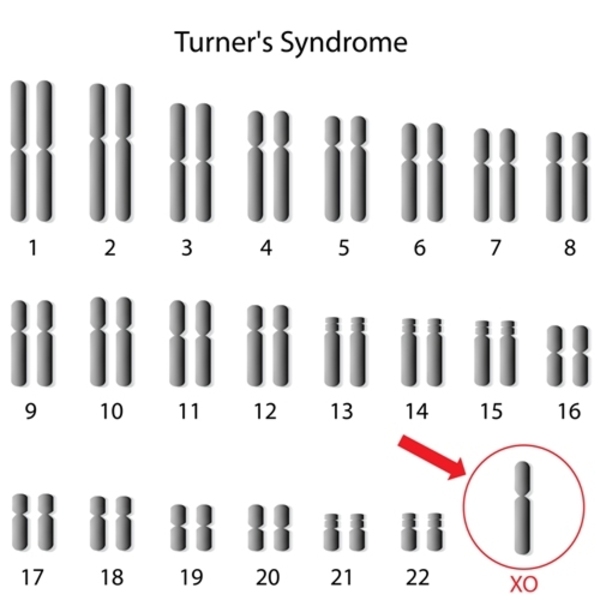 figure3)Turners Syndrome