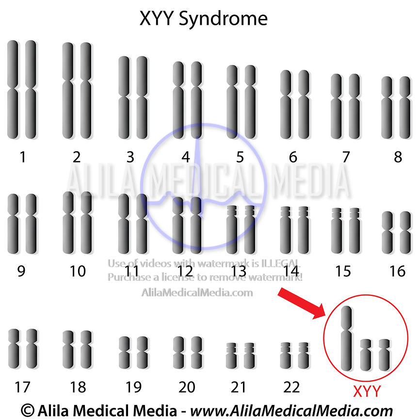 figure4)super-male-Syndrome